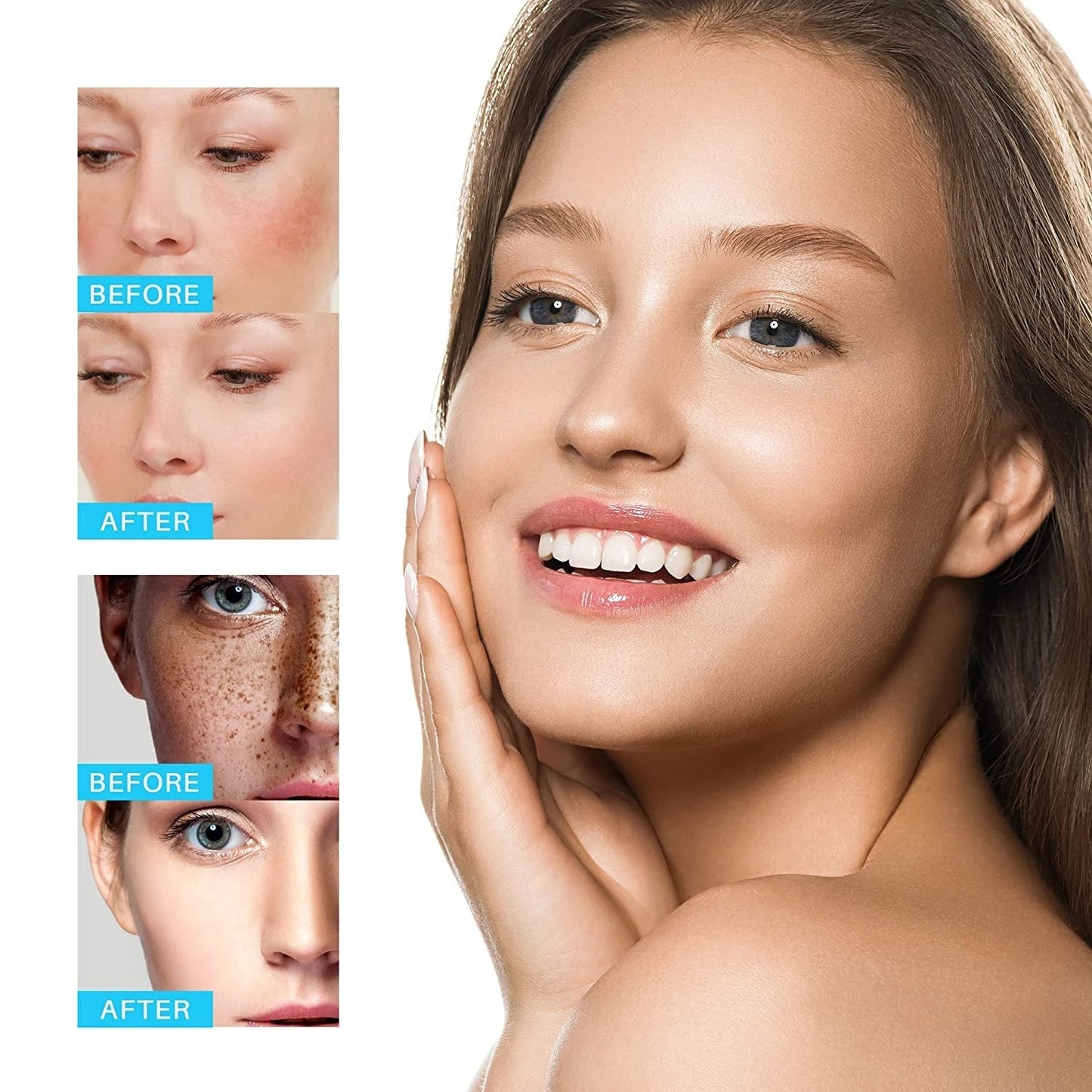 Whitening Freckle Cream Remove Melasma