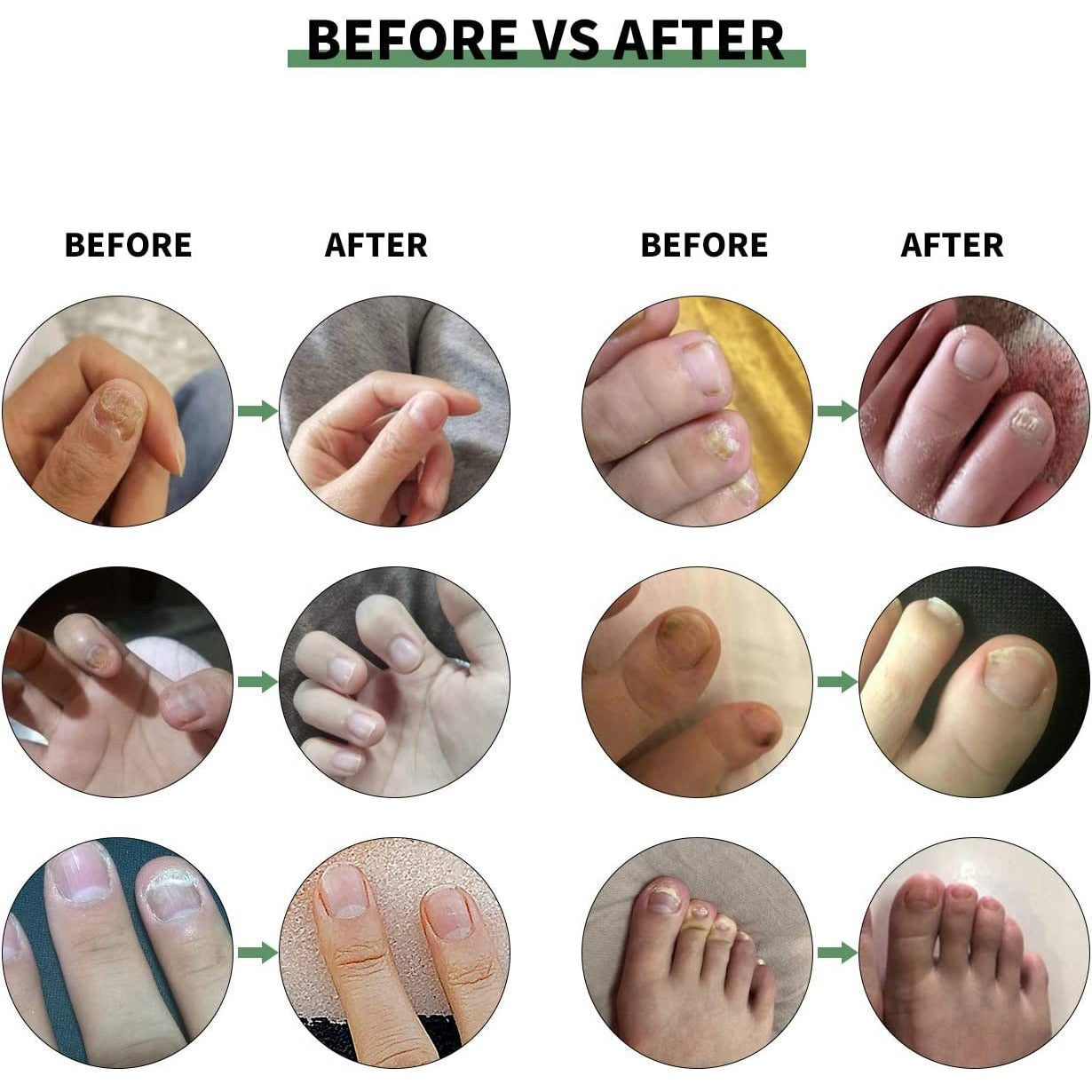 Nail Fungus Treatment Essence Toe Repair
